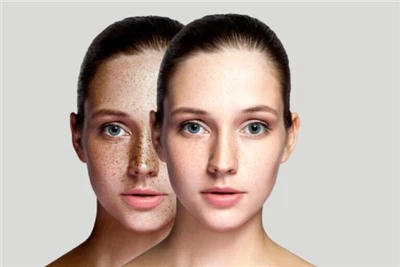 Fractional CO2 Laser Skin Resurfacing: The Ultimate Guide to Laser Skin Rejuv...