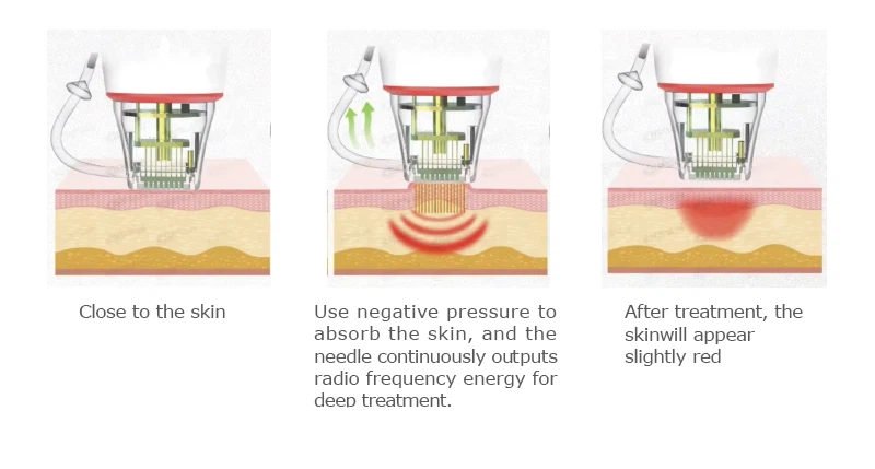 Treatment Principle of RF Microneedling Machine Treatment Principle of RF Microneedling Machine